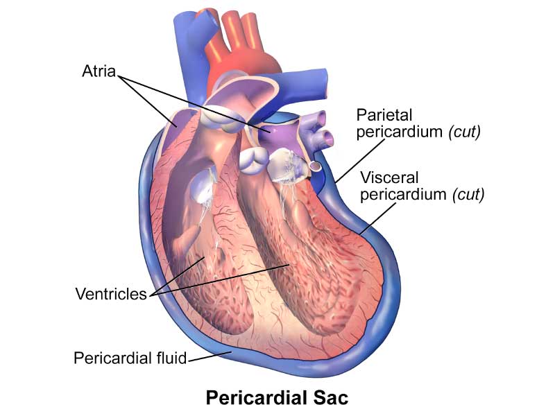 Pericardial mesothelioma affecting heart lining