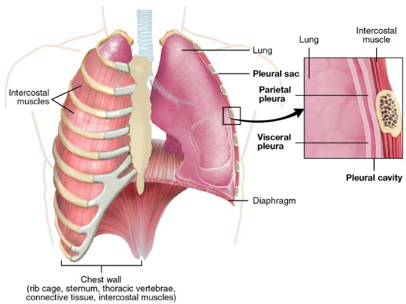 Pleural mesothelioma affecting lung lining