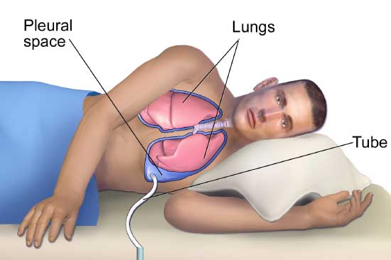 Pleurodesis treatment for mesothelioma