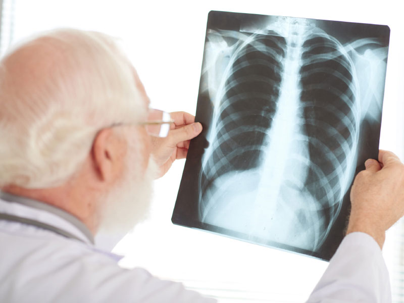 Doctor reviewing chest X-ray for pleural effusion claim