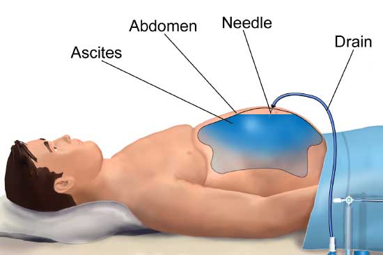 Paracentesis treatment for mesothelioma symptoms