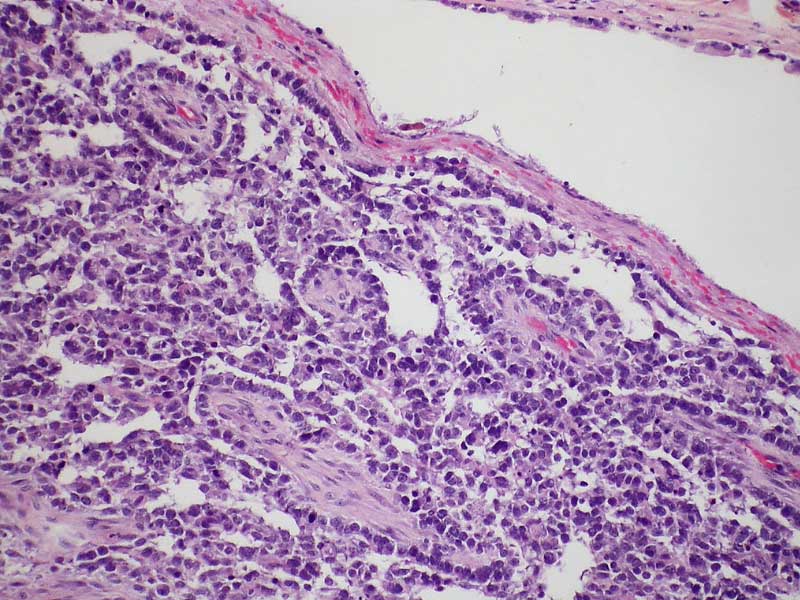Testicular mesothelioma claim information