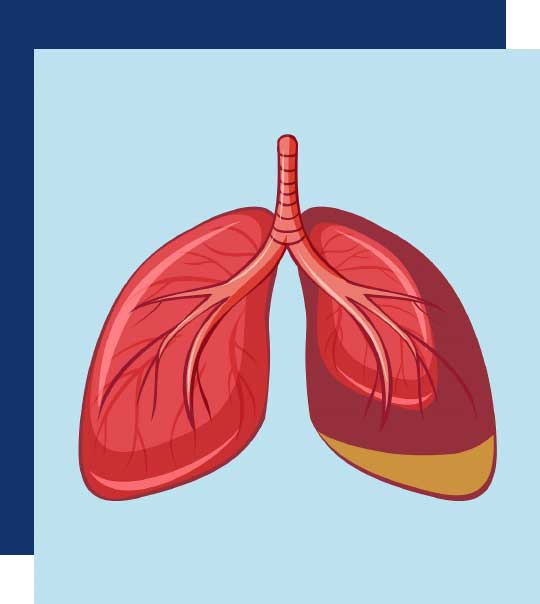Lungs affected by mesothelioma and asbestos exposure