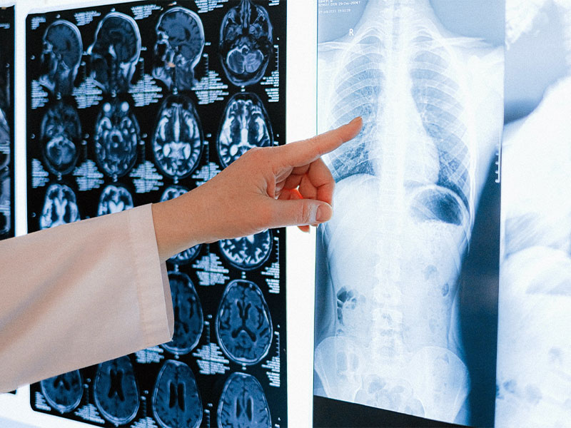 Doctor reviewing X-ray for mesothelioma diagnosis