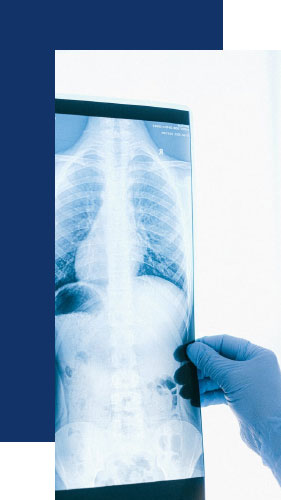 Chest X-ray for asbestos lung cancer diagnosis